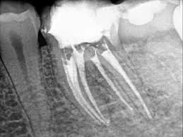 Endodoncias multirradiculares